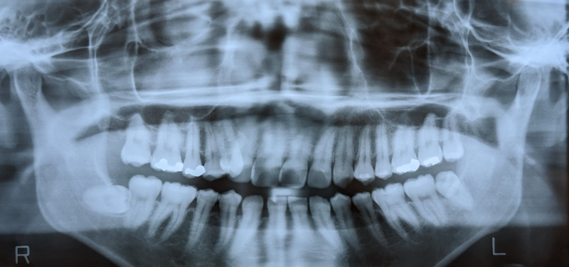 親知らずが映ったレントゲン